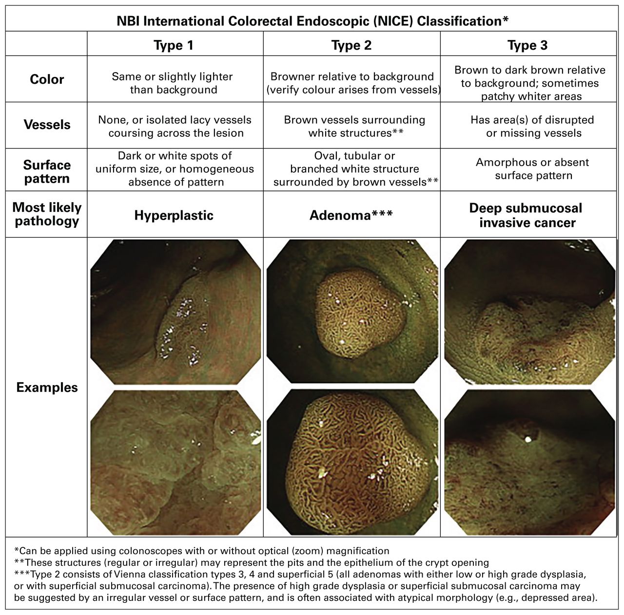 Colon polyps types