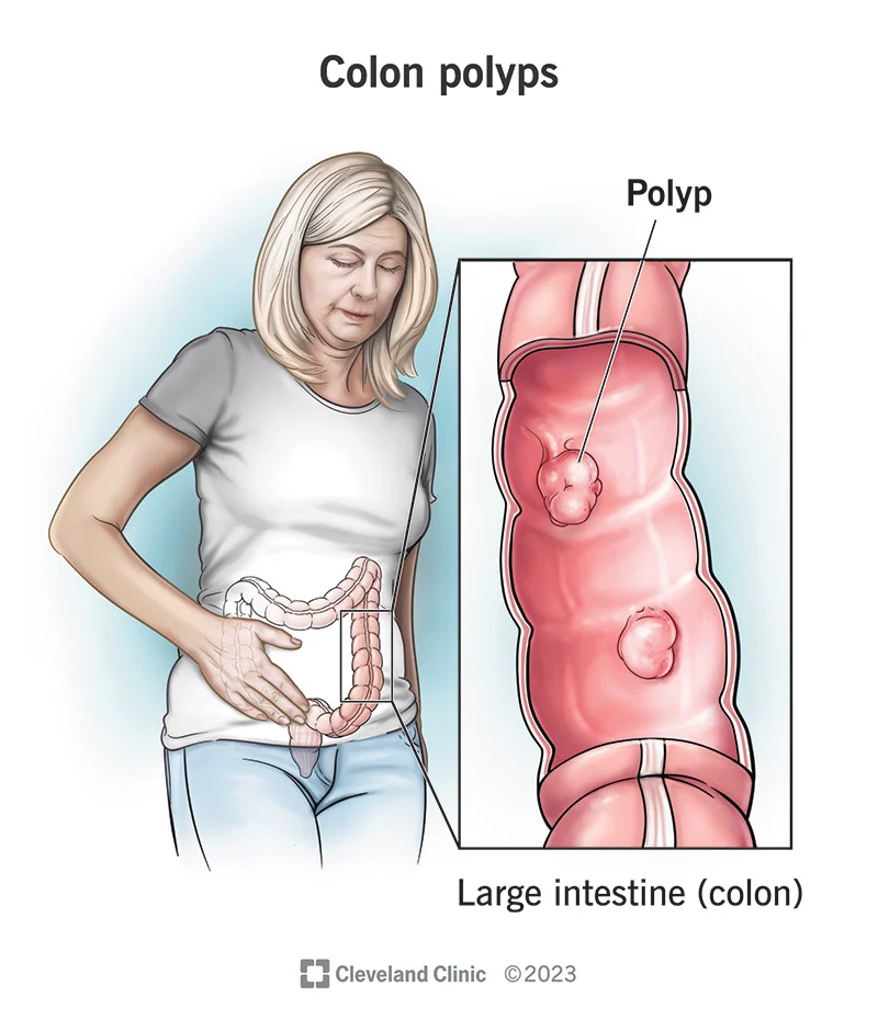 Colon polyps  growths 