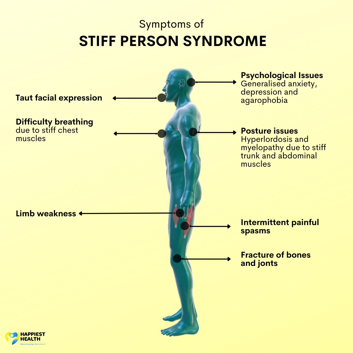 Stiff-Person Syndrome