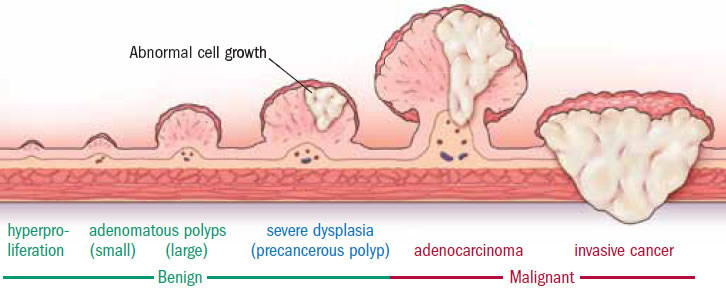 Colon polyps  growths 