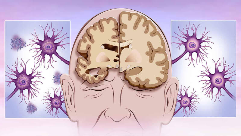 alzheimer's and its symptoms