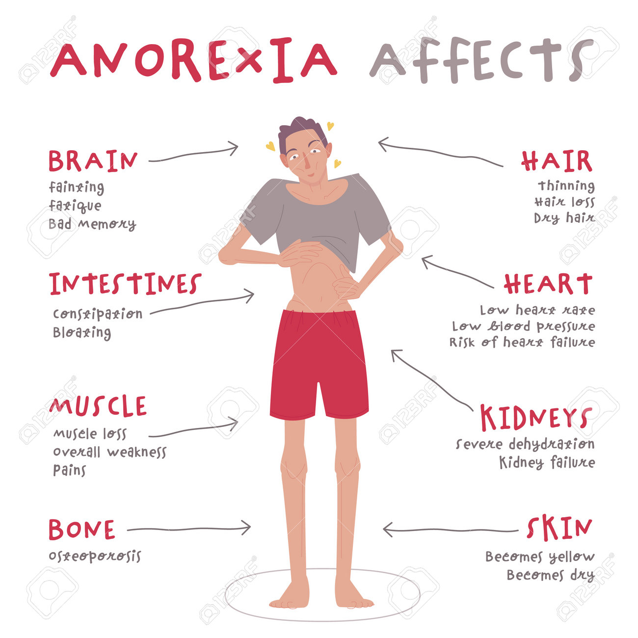 Connection Between Early Birds and Anorexia Nervosa