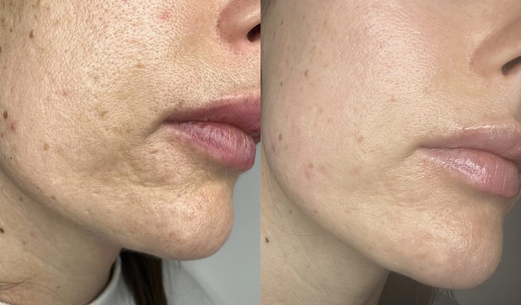 Magic of CO2 Laser Resurfacing